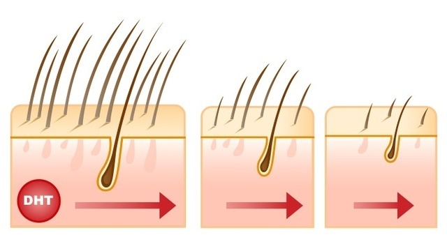 l’alopecia 